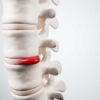 Hernie discale : Peut-on éviter la chirurgie grâce à la chiropratique ?