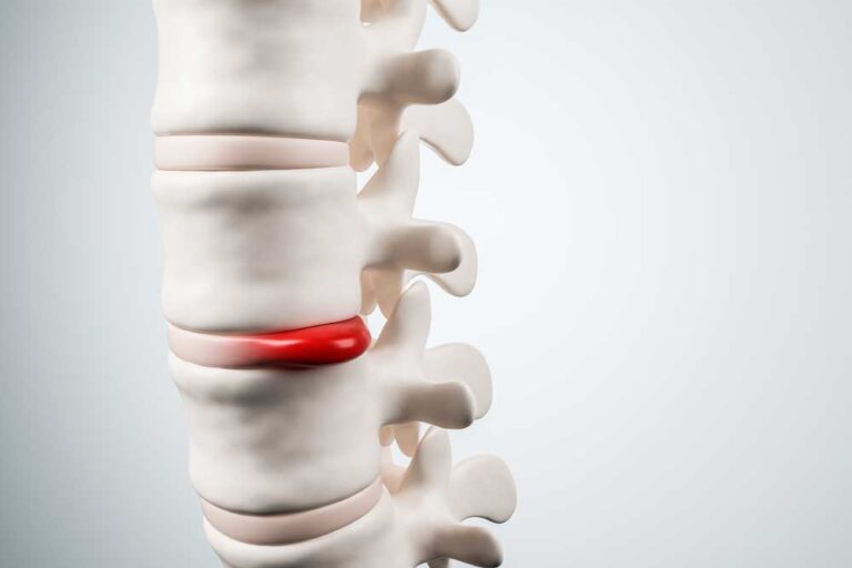 Image de :Hernie discale : Peut-on éviter la chirurgie grâce à la chiropratique ?